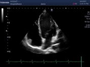 心臓超音波の画像